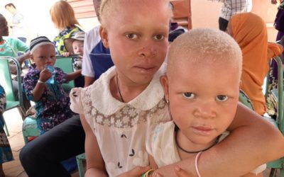 Journée internationale de sensibilisation sur l’albinisme