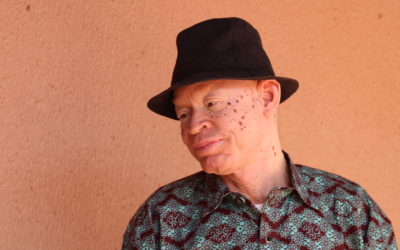 Fabéré Sanon : « J’ai difficilement vécu l’albinisme durant mon enfance. »