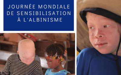 L’ignorance autour de l’albinisme conduit à l’exclusion des enfants malades